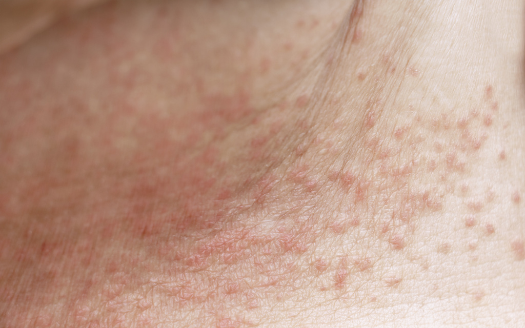 Suncare Central Blog Image: How To Prevent Heat Rash / Prickly Heat